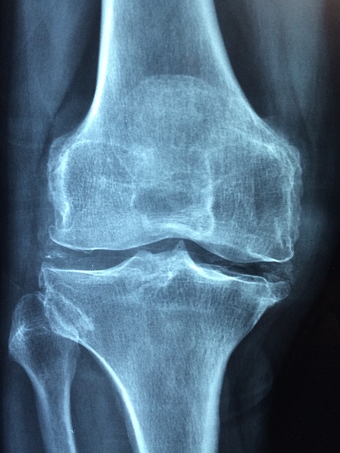 What happens when I have osteoarthritis?